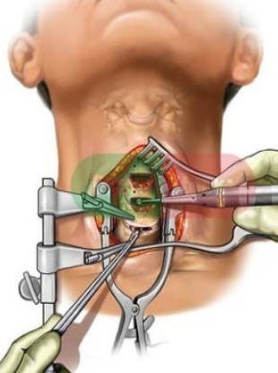 Cervical Spine Surgery in Ahmedabad, Gujarat, India